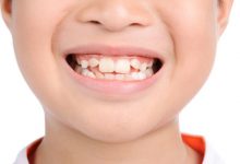 Các mẹ cần biết những "thủ phạm" khiến răng trẻ mọc lệch để có thể điều chỉnh kịp thời