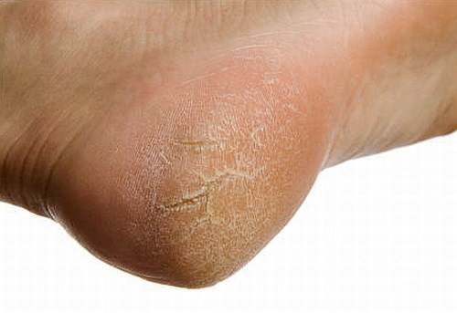 Nếu thấy những dấu hiệu "lạ" ở bàn chân thì rất có thể gan của bạn đang gặp nguy hiểm từng ngày.