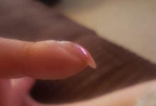 Cảnh giác nguy cơ mắc ung thư phổi qua những dấu hiệu của ngón tay