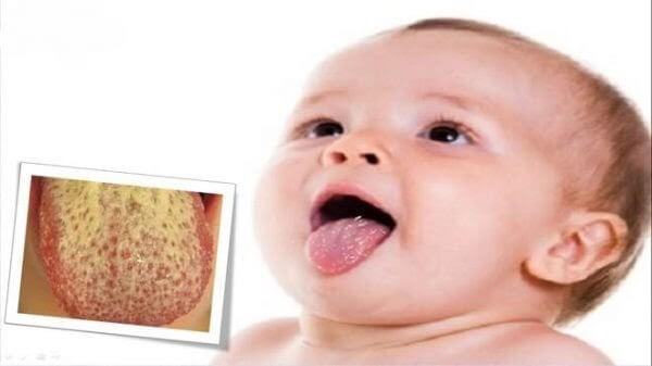 Nấm lưỡi ở trẻ sơ sinh và cách điều trị tại nhà hiệu quả