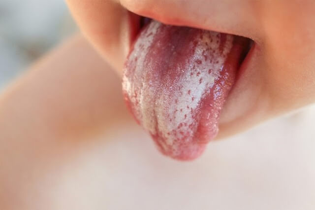 Cách chữa bệnh tưa lưỡi ở trẻ nhỏ