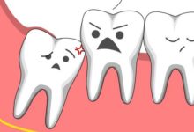 Tác hại của Răng khôn mọc lệch