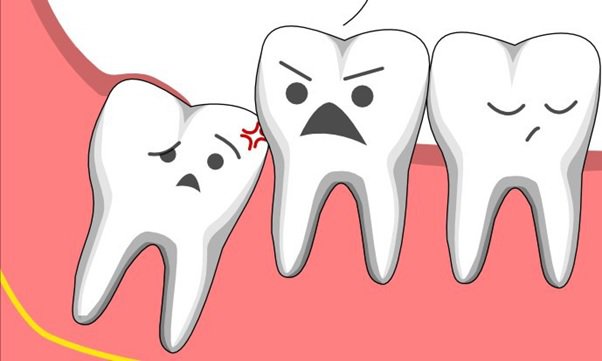 Tác hại của Răng khôn mọc lệch