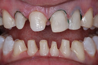 Sửa Soạn Răng Mài Cùi Răng
