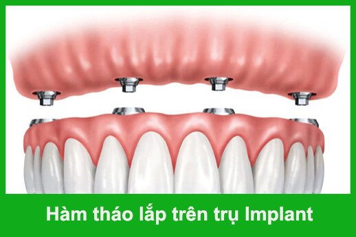 Ham Taho Lap Tren Implant
