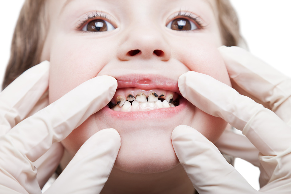 bệnh sâu răng ở trẻ nhỏ